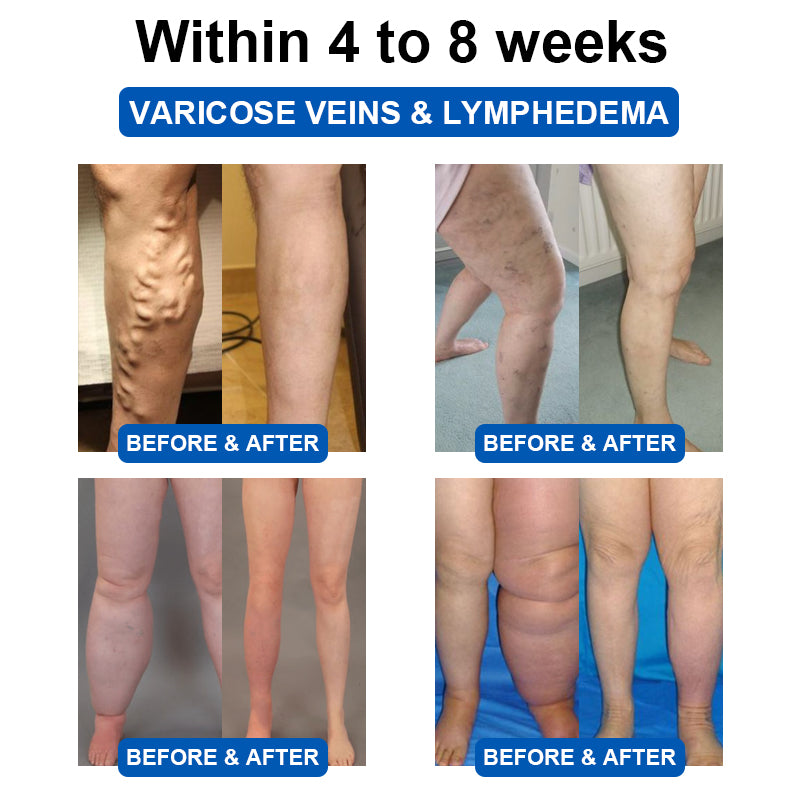 ✅MHRA Approved | GFOUK™ Ultrasonic Fat Blasting and Detox Wristband (🔥UP TO 70% OFF)